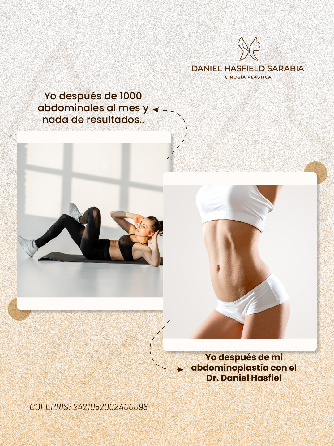 Comparativa entre ejercicio abdominal y resultado de abdominoplastia