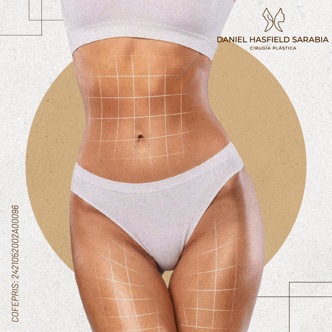 Mapeo de las zonas corporales que se trabajan en una lipoescultura: abdomen, flancos y muslos
