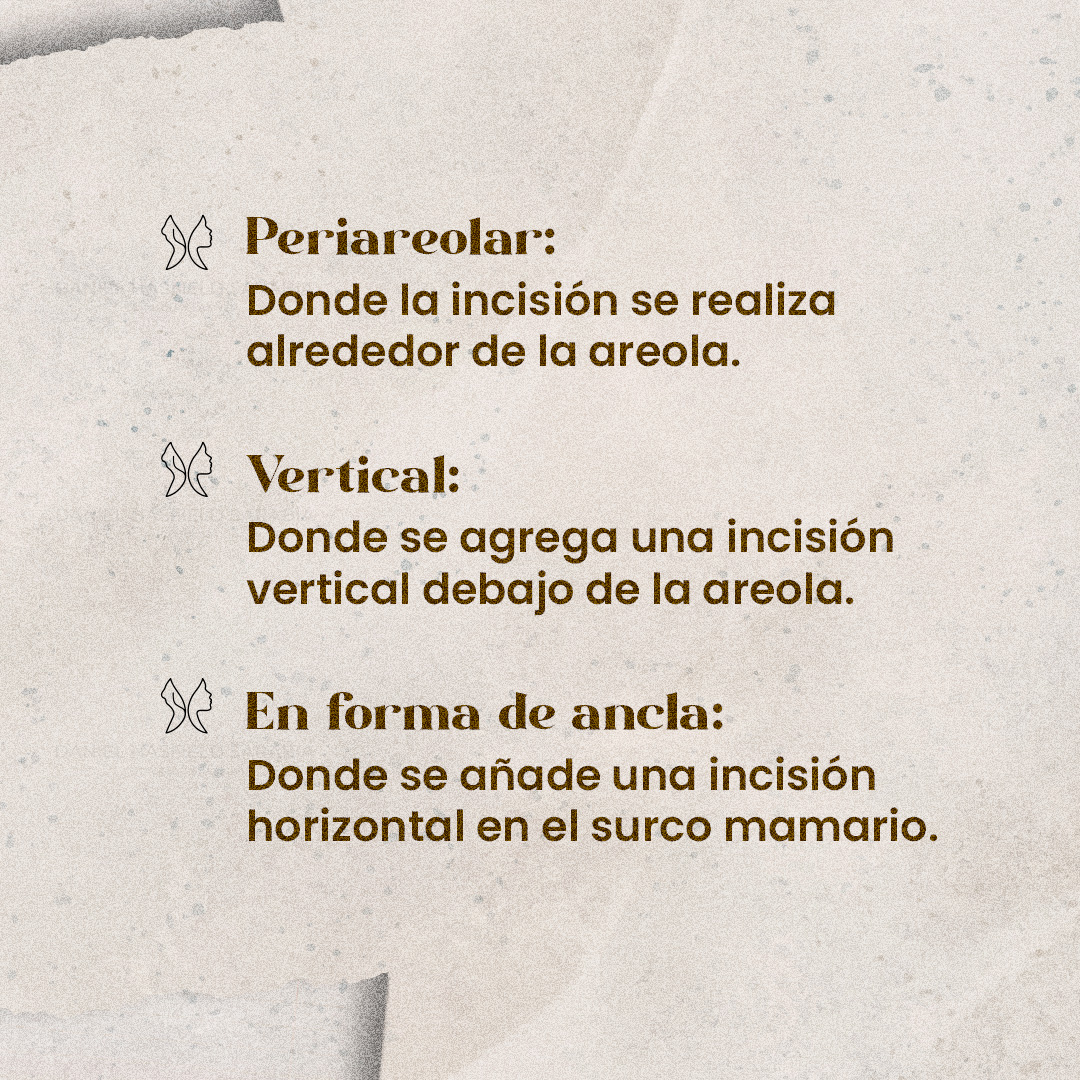 Tipos de mastopexia: periareolar, vertical y en forma de ancla