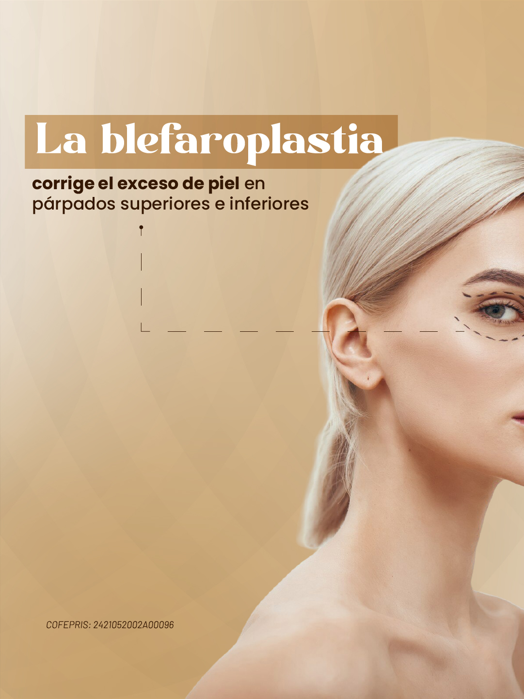 La blefaroplastia corrige el exceso de piel en párpados superiores e inferiores