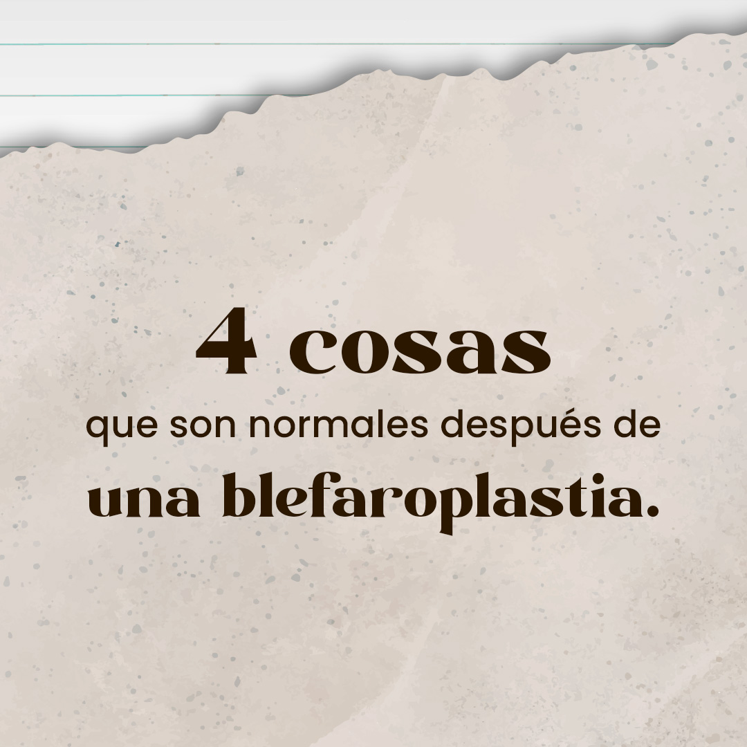 4 cosas que son normales después de una blefaroplastia
